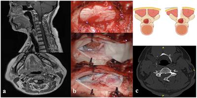 Unilateral hemilaminectomy vs. laminoplasty for the resection of spinal schwannomas: an analysis of 100 patients